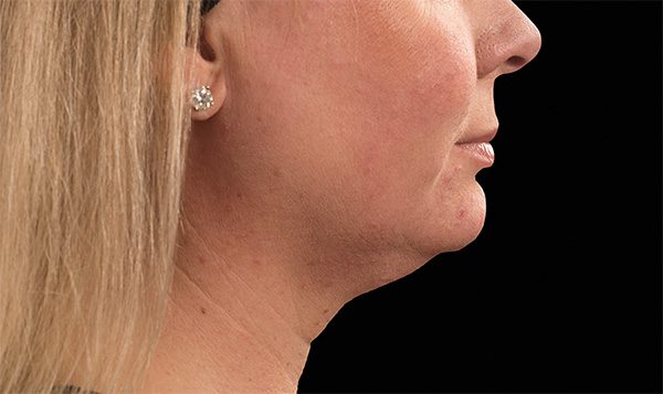 Before Coolsculpting Face - Spa Services and Spa Treatment in Birmingham | Spa Cahaba