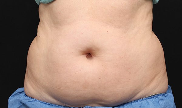 Before - Coolsculpting Abdomen - Spa Services and Spa Treatment in Birmingham | Spa Cahaba