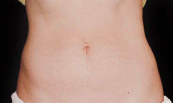Coolsculpting - Abdomen After - Spa Services and Spa Treatment in Birmingham | Spa Cahaba