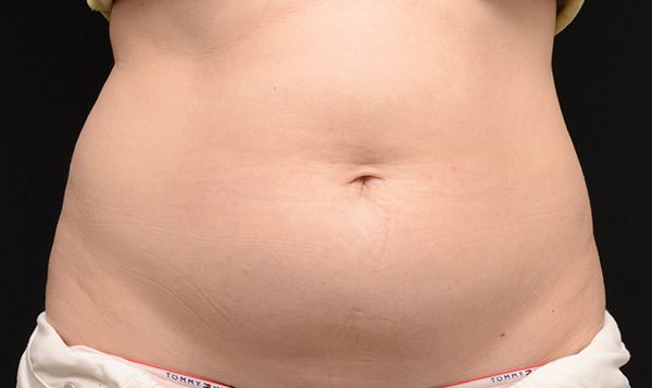 Coolsculpting Abdomen Before - Spa Services and Spa Treatment in Birmingham | Spa Cahaba