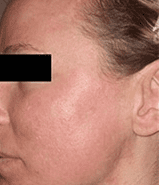 Chemical Peel facial after - Spa Services and Spa Treatment in Birmingham | Spa Cahaba