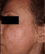 Chemical Peel facial before - Spa Services and Spa Treatment in Birmingham | Spa Cahaba