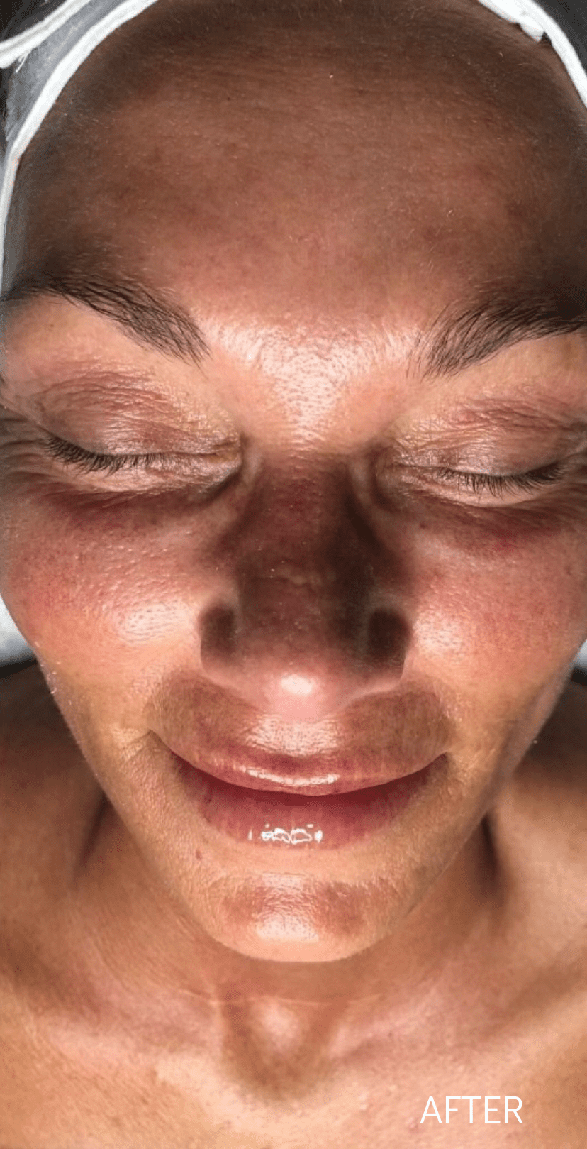 Microdermabrasion After - Spa Services and Spa Treatment in Birmingham | Spa Cahaba