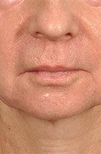 microneedling1 after - Spa Services and Spa Treatment in Birmingham | Spa Cahaba