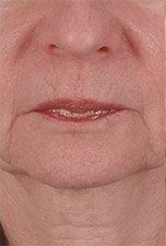 microneedling1 before - Spa Services and Spa Treatment in Birmingham | Spa Cahaba