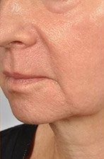 microneedling2 after - Spa Services and Spa Treatment in Birmingham | Spa Cahaba