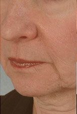 microneedling2 before - Spa Services and Spa Treatment in Birmingham | Spa Cahaba
