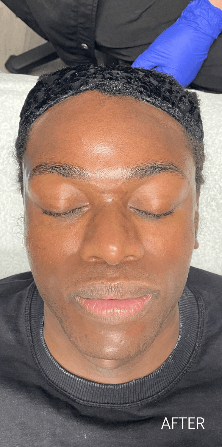 Micro Needling After - Spa Services and Spa Treatment in Birmingham | Spa Cahaba