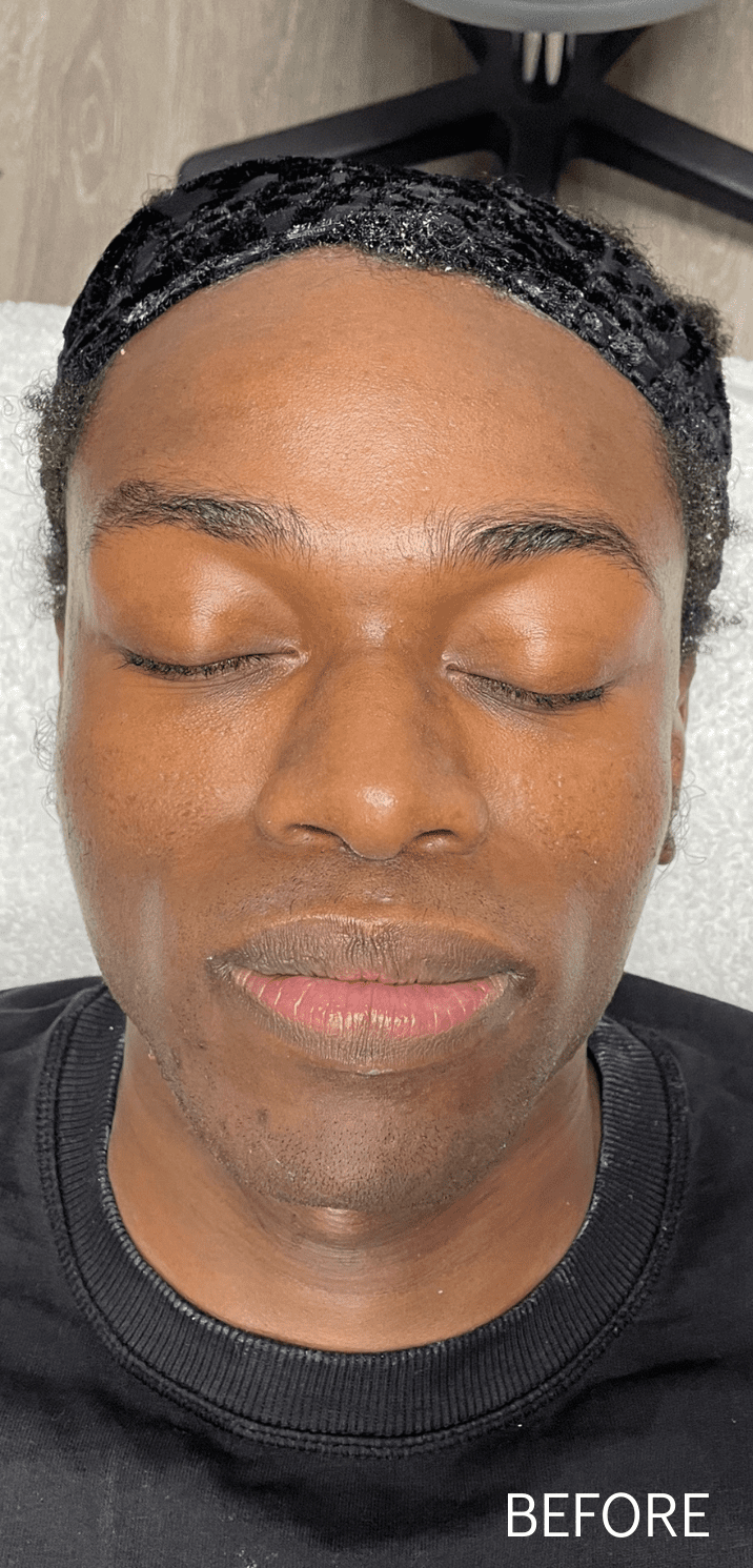 Micro Needling Before - Spa Services and Spa Treatment in Birmingham | Spa Cahaba
