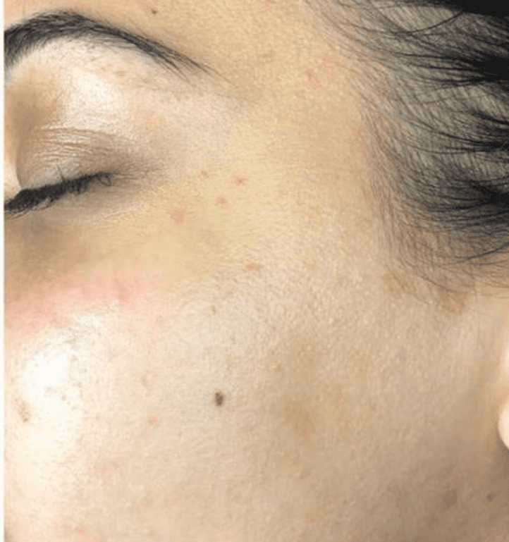 Dermaplaning - After 2 - Spa Services and Spa Treatment in Birmingham