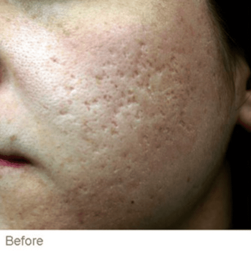 Ematrix Before - Spa Services and Spa Treatment in Birmingham | Spa Cahaba