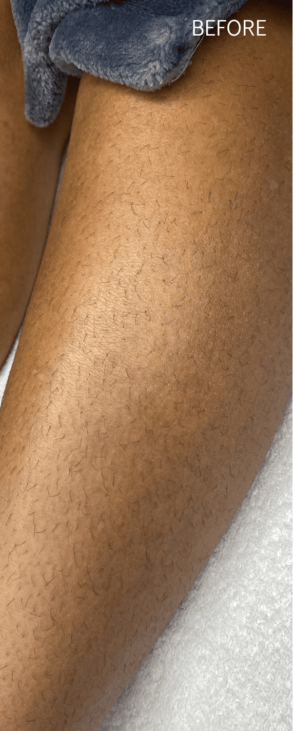 Waxing Before - Spa Services and Spa Treatment in Birmingham | Spa Cahaba