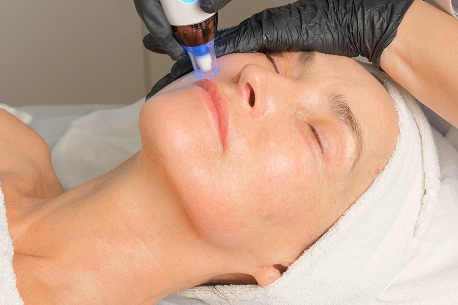 Microneedling at Spa Cahaba in Birmingham, AL
