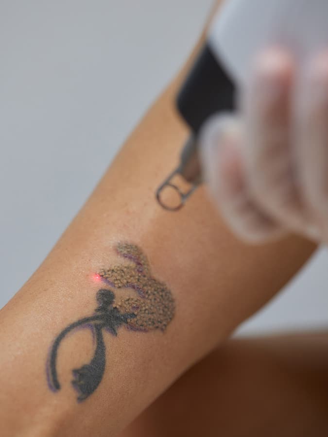 Laser Tattoo Removal at Spa Cahaba