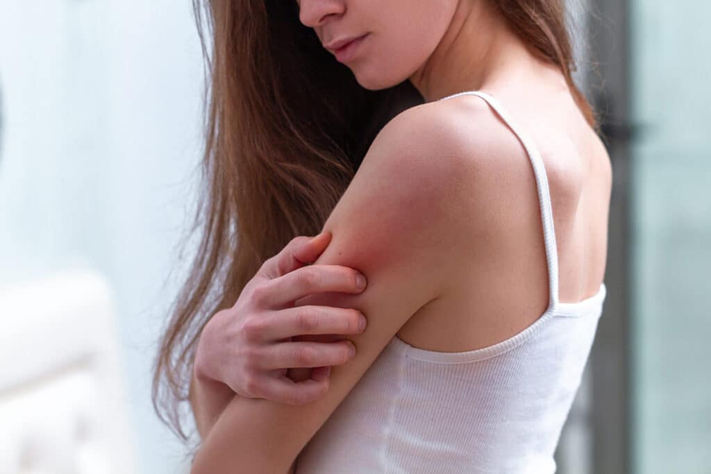 Common Rashes